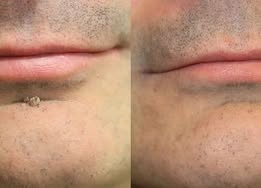 ✨Curalona® Cerotto 2 in 1 con Microneedle e Idrocolloide 🍀 | Aiuta a rimuovere nei in rilievo, acne, verruche piane e fibromi cutanei | Contribuisce a migliorare rughe, cicatrici e imperfezioni della pelle | Cerotti invisibili per viso e corpo