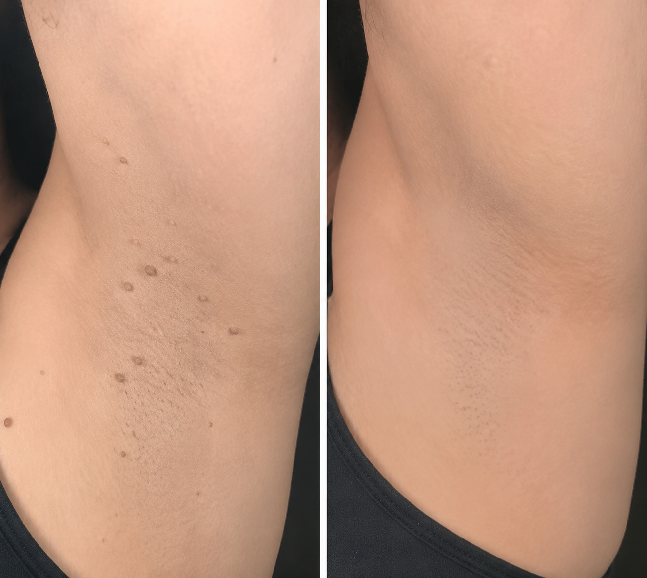 ✨Curalona® Cerotto 2 in 1 con Microneedle e Idrocolloide 🍀 | Aiuta a rimuovere nei in rilievo, acne, verruche piane e fibromi cutanei | Contribuisce a migliorare rughe, cicatrici e imperfezioni della pelle | Cerotti invisibili per viso e corpo