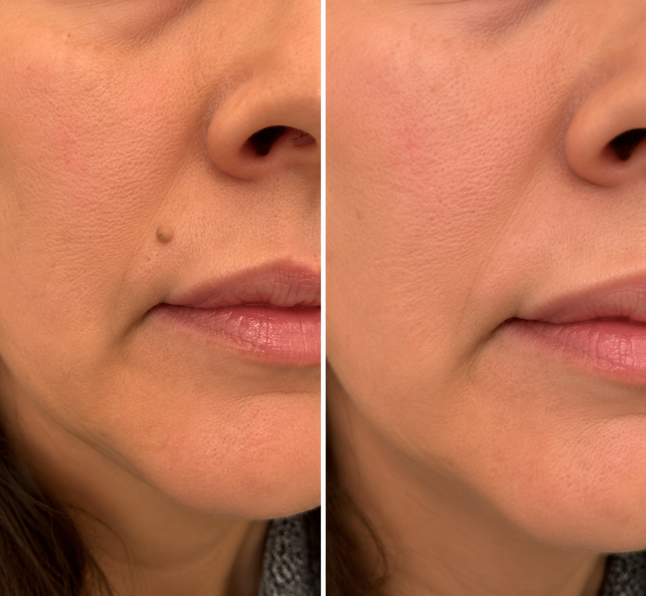 ✨Curalona® Cerotto 2 in 1 con Microneedle e Idrocolloide 🍀 | Aiuta a rimuovere nei in rilievo, acne, verruche piane e fibromi cutanei | Contribuisce a migliorare rughe, cicatrici e imperfezioni della pelle | Cerotti invisibili per viso e corpo