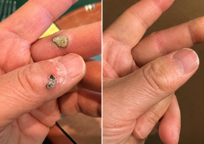 ✨Curalona® Cerotto 2 in 1 con Microneedle e Idrocolloide 🍀 | Aiuta a rimuovere nei in rilievo, acne, verruche piane e fibromi cutanei | Contribuisce a migliorare rughe, cicatrici e imperfezioni della pelle | Cerotti invisibili per viso e corpo
